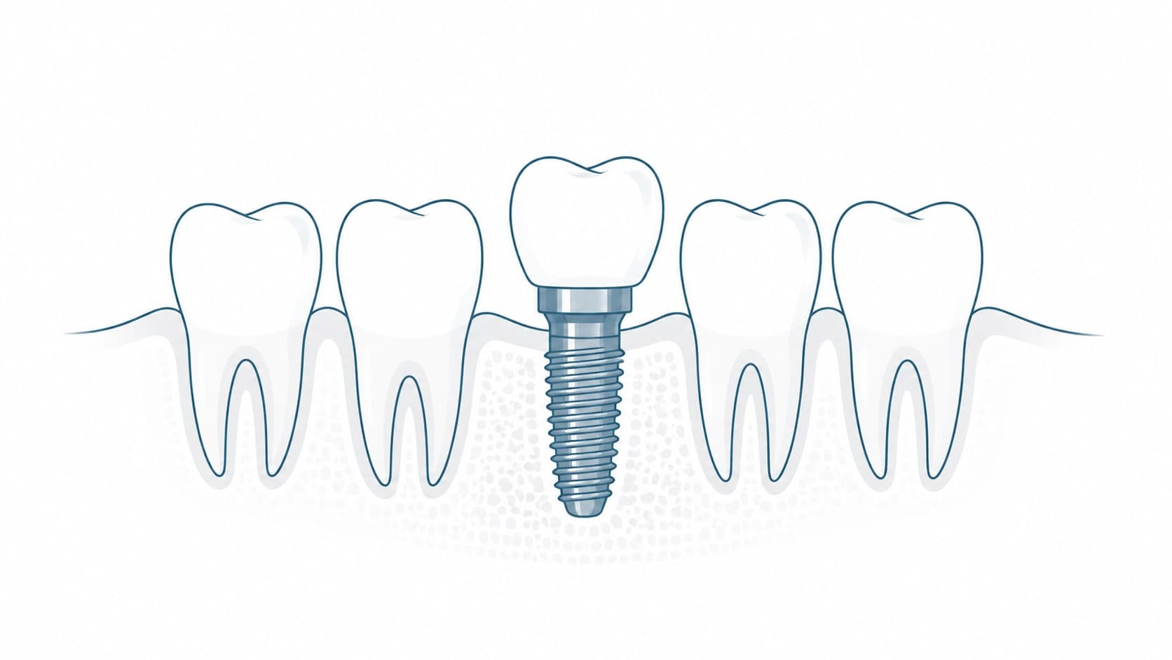 Implante dental unitario