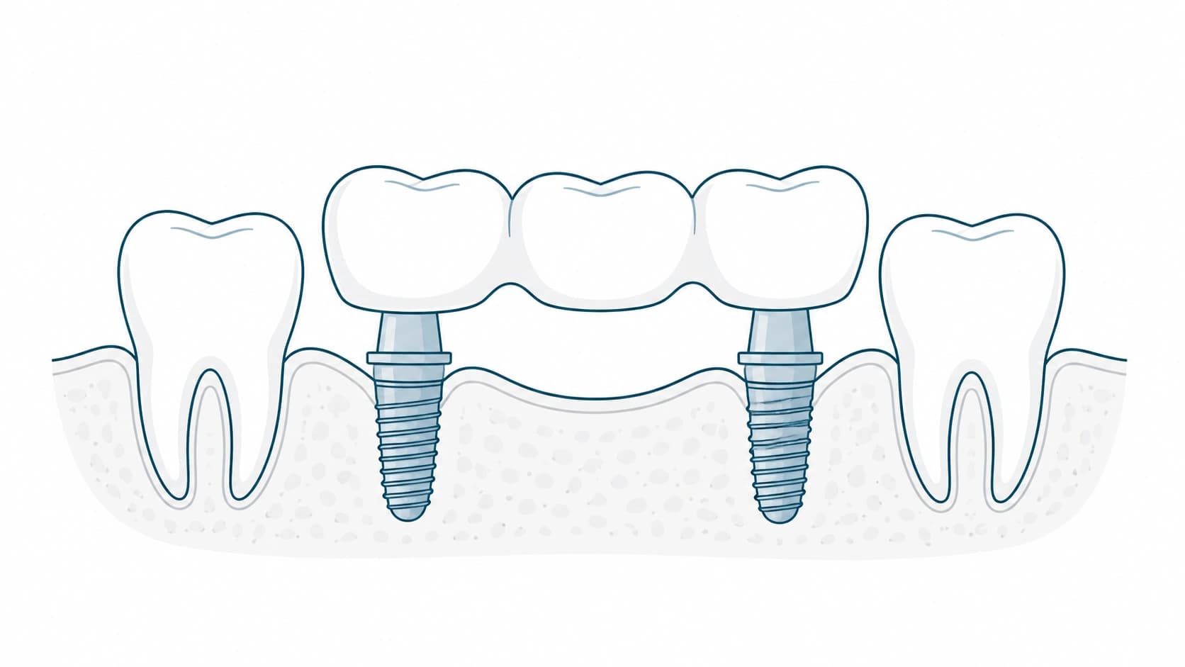 Puente sobre implantes para varios dientes