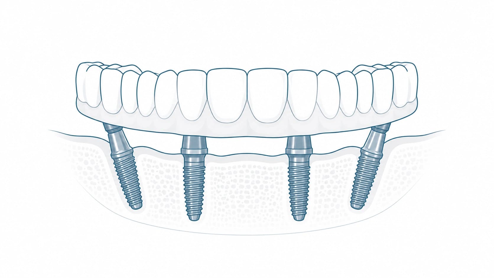 Prótesis fija completa sobre implantes