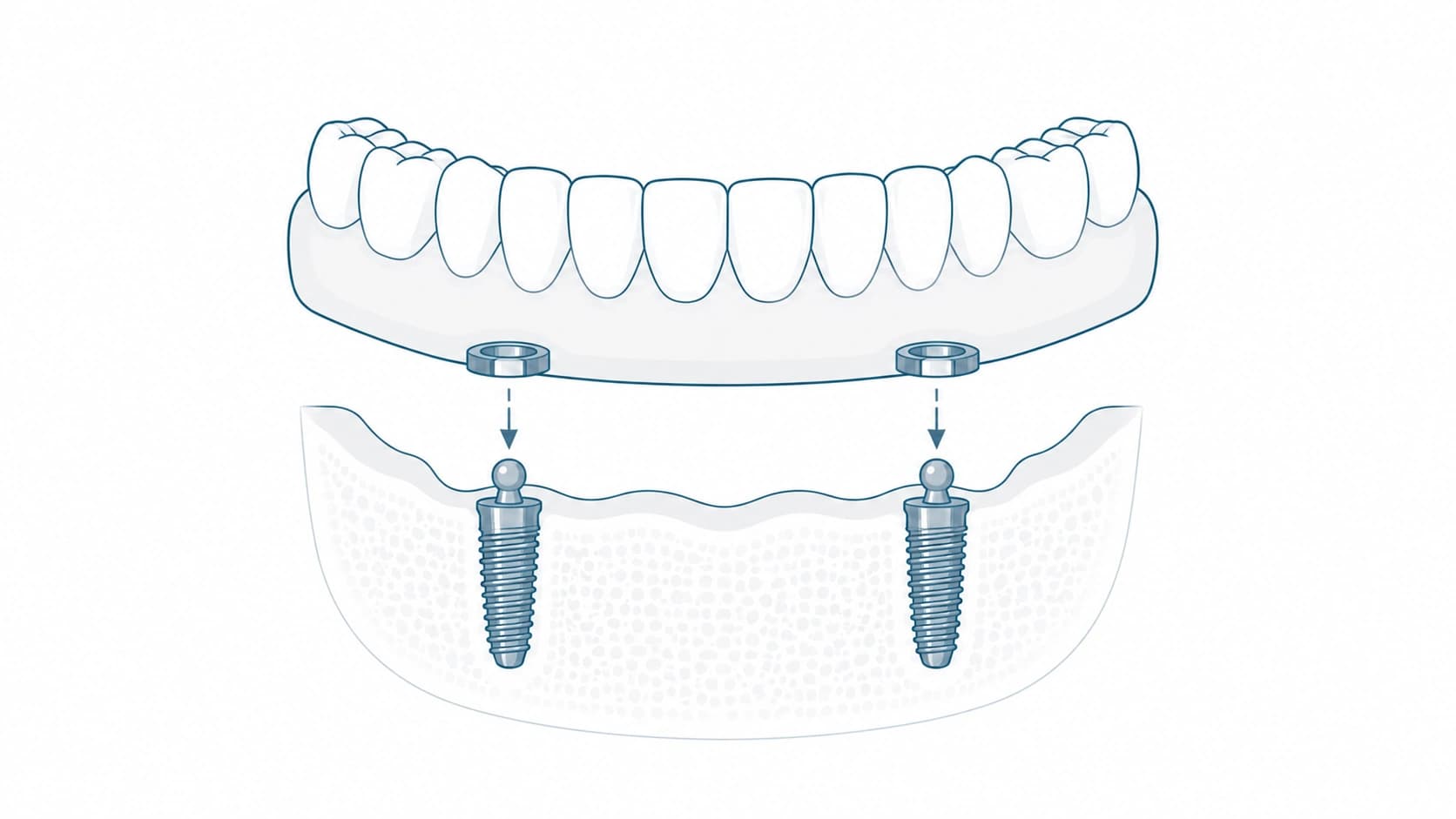 Sobredentadura estabilizada con implantes