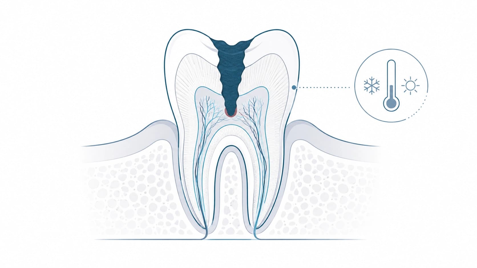 Caries profunda que puede requerir endodoncia