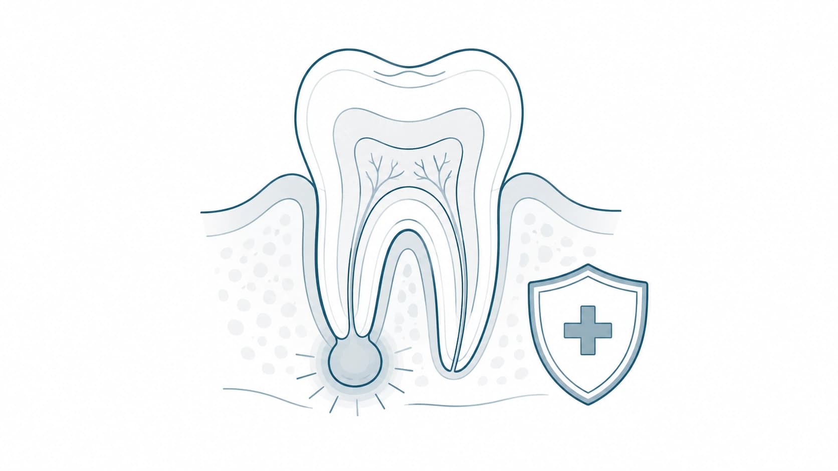 Absceso o infección dental