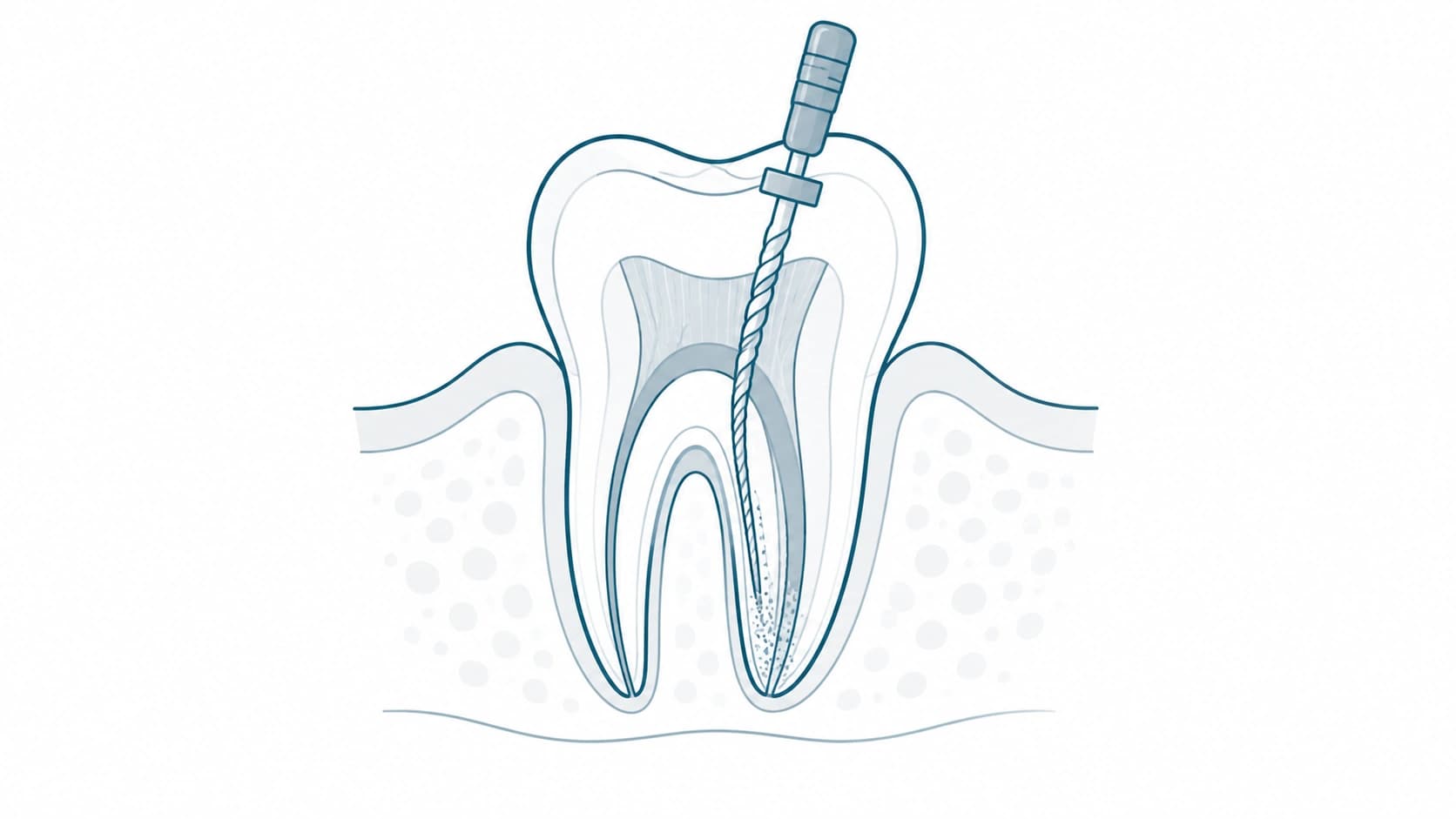 Retratamiento de endodoncia