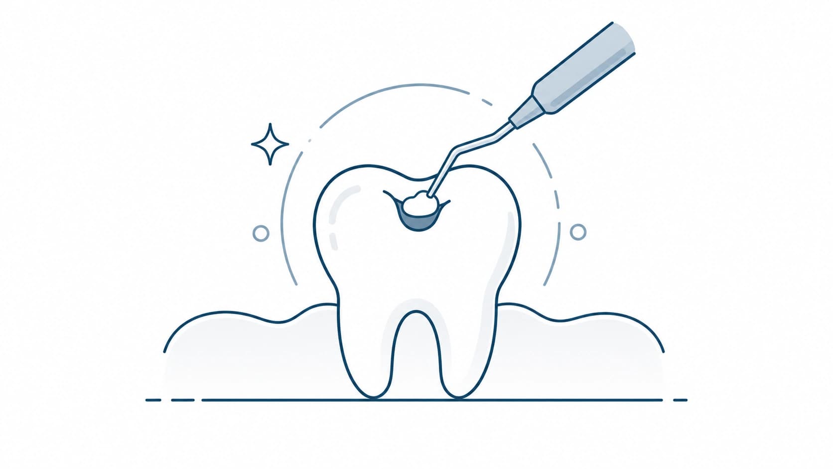 Tratamiento de caries dental