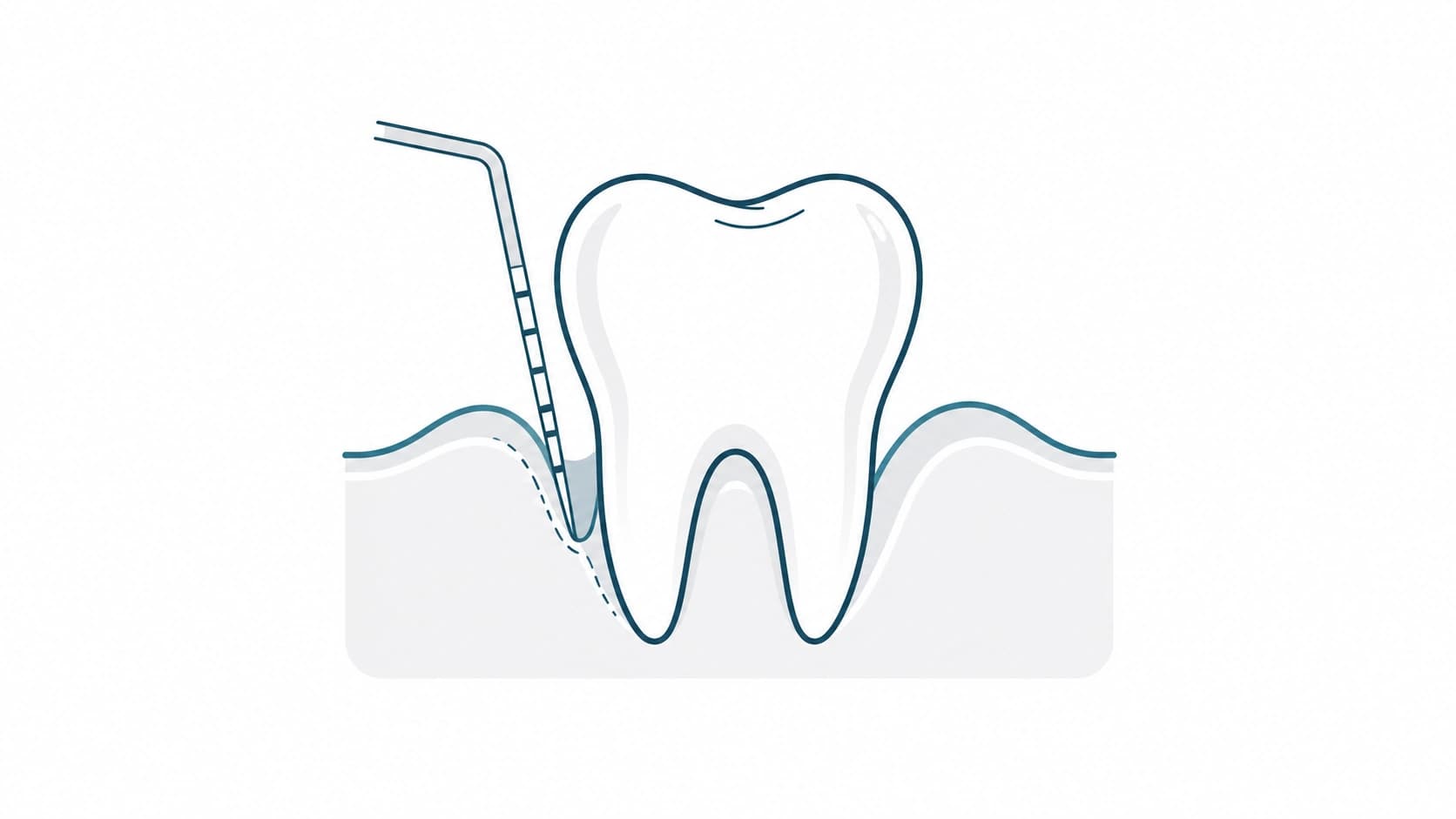 Medición de bolsas periodontales