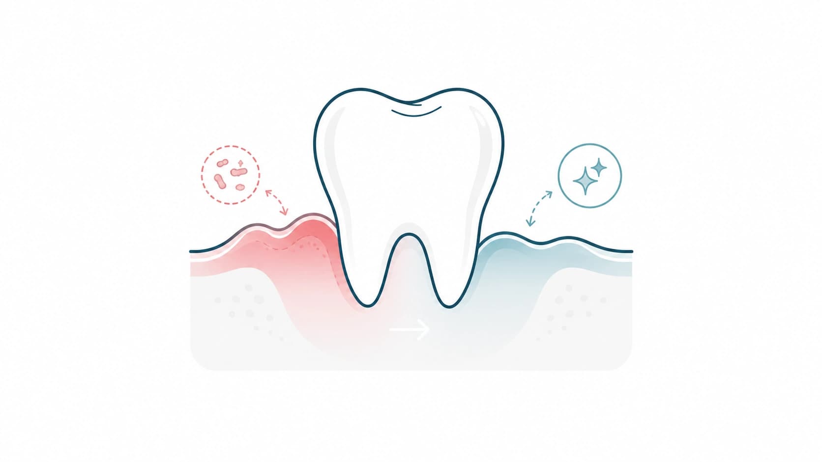 Tratamiento de gingivitis