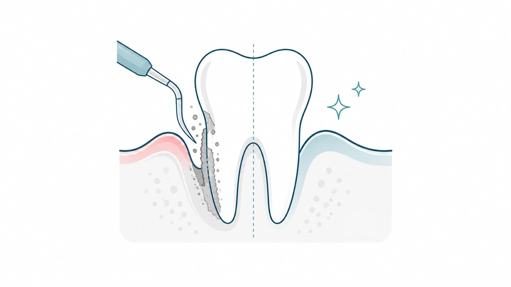 Control de periodontitis