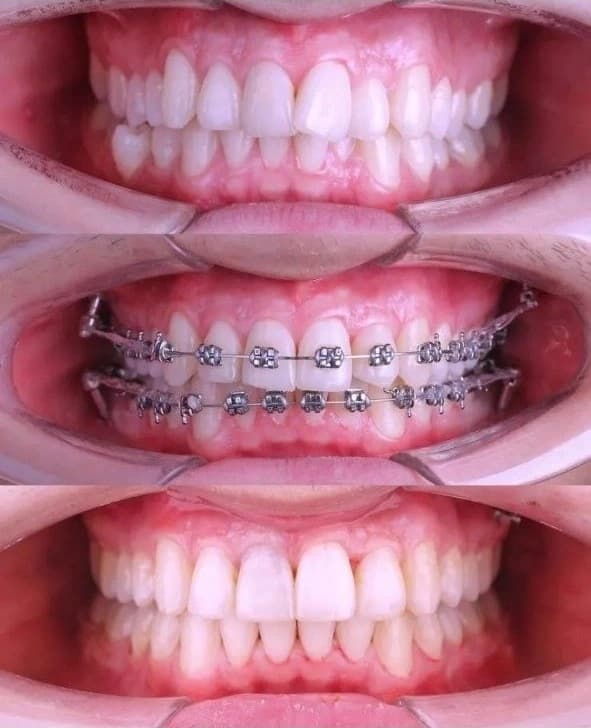 Caso clínico: Corrección de mordida con brackets