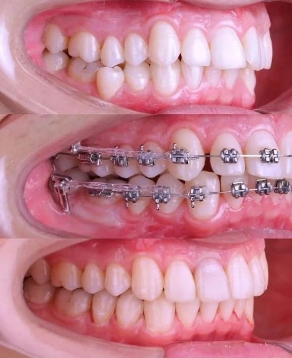 Caso clínico: Alineación dental con brackets