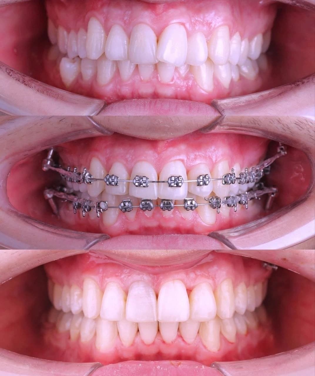 Caso clínico: Cierre de espacios y alineación dental