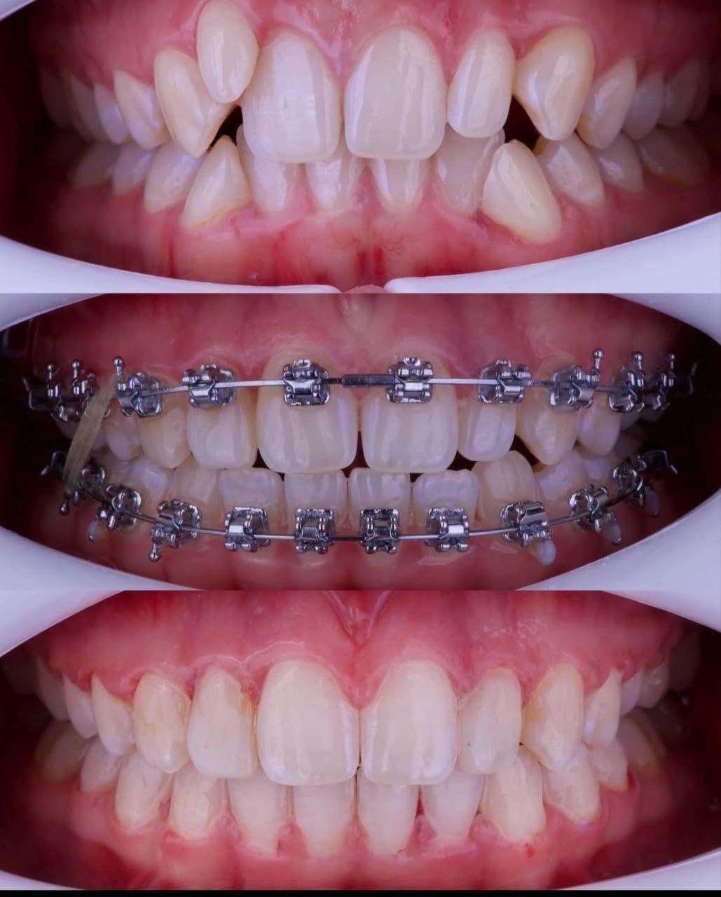 Caso clínico: Tratamiento de apiñamiento dental