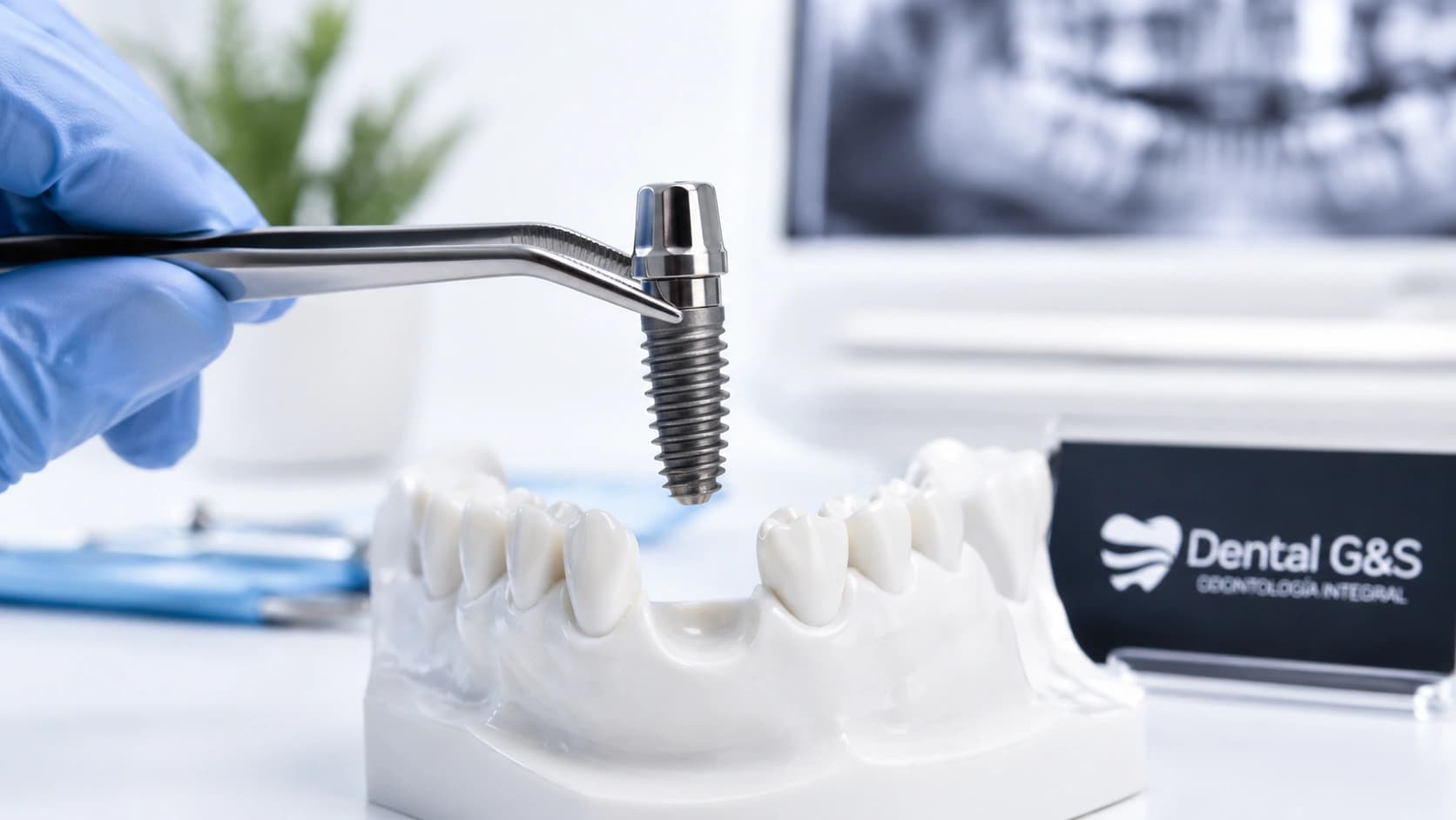 Modelo de implante dental para guía sobre implantes en Huacho y Barranca
