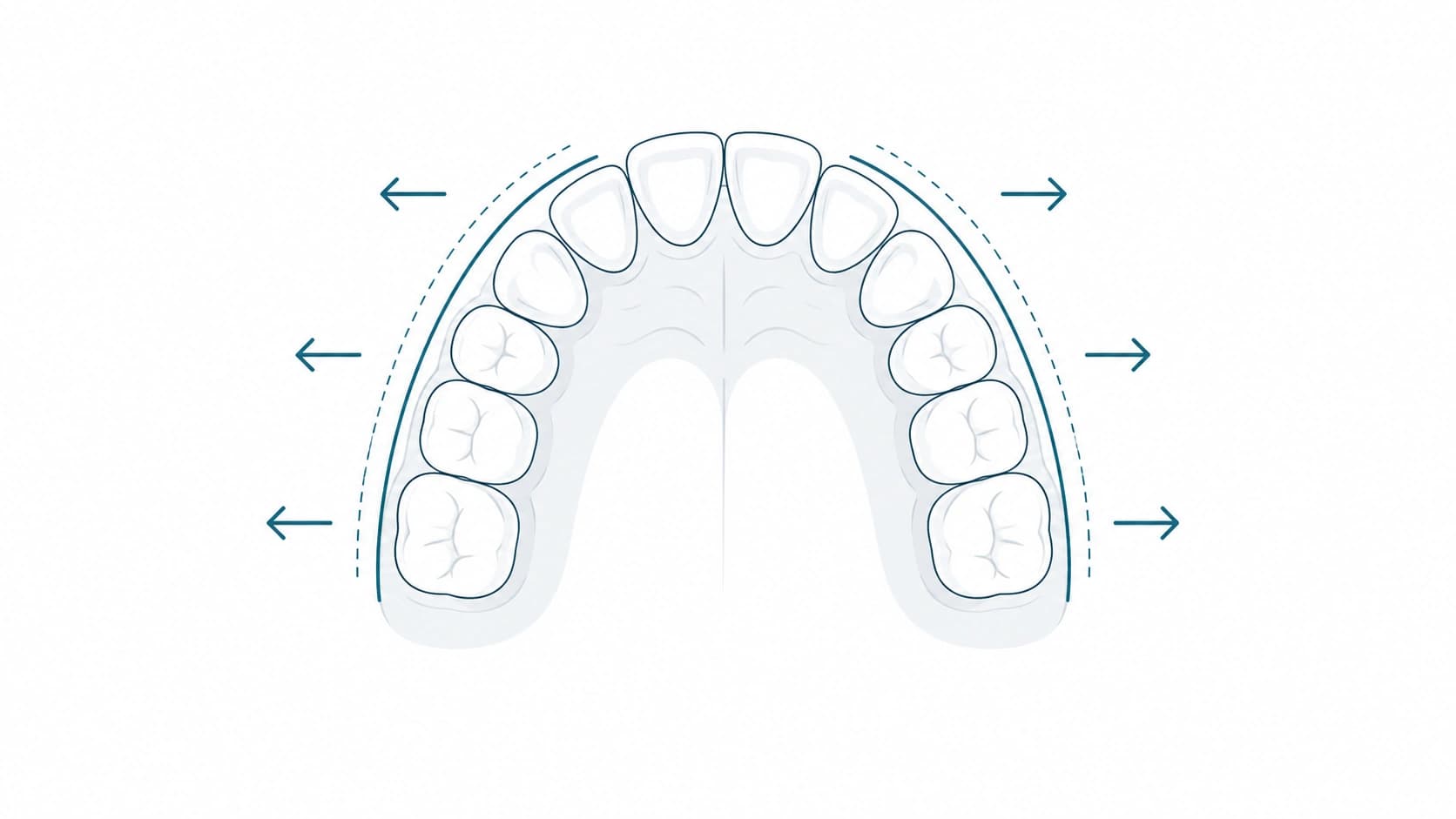 Tratamiento para crear espacio dental