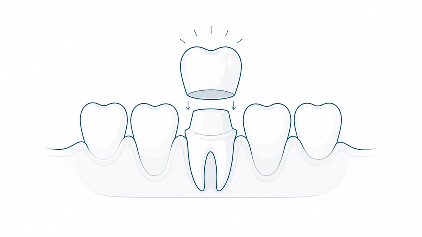 Corona dental de alta estética