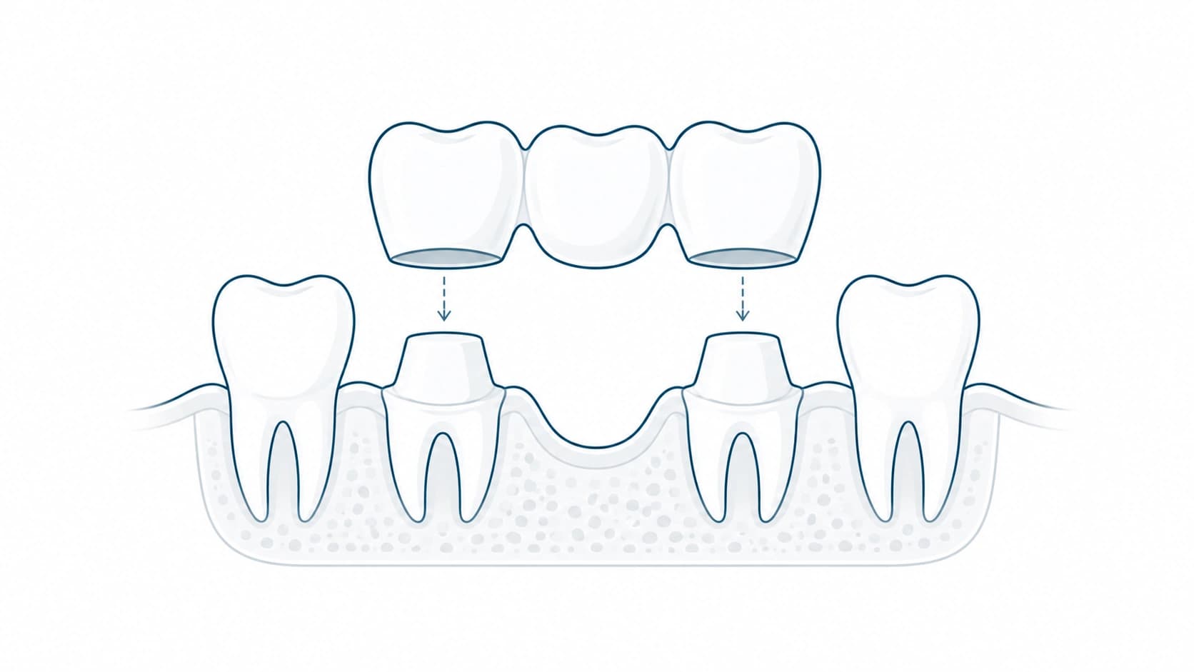 Puente fijo para reemplazar dientes ausentes