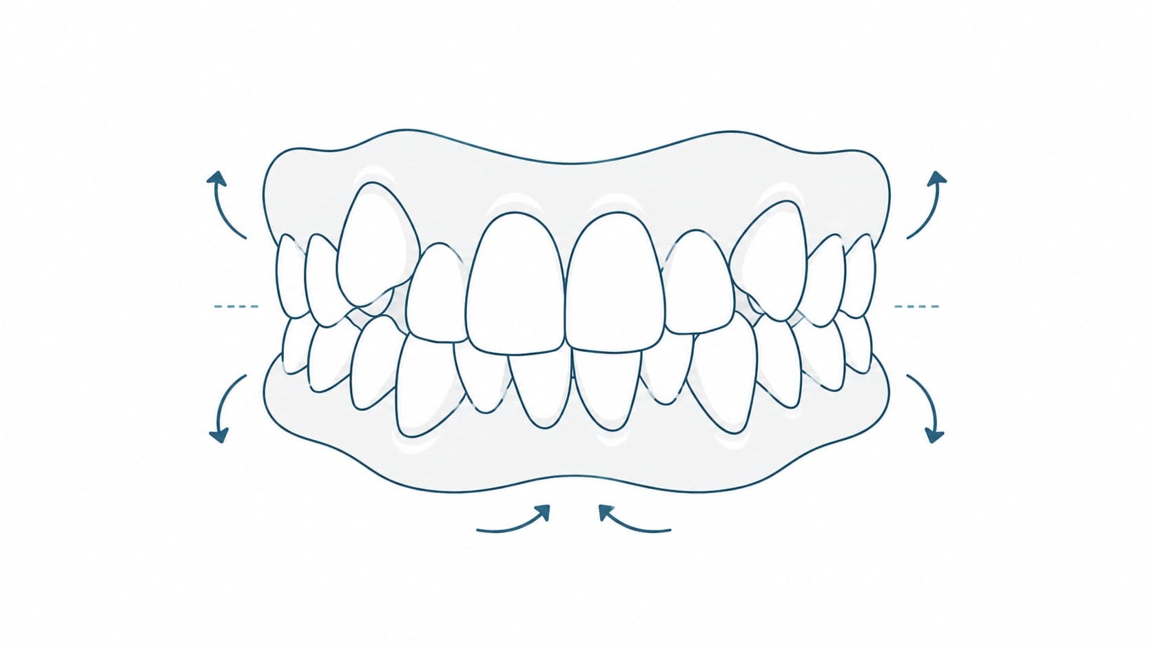Alineadores para dientes apiñados