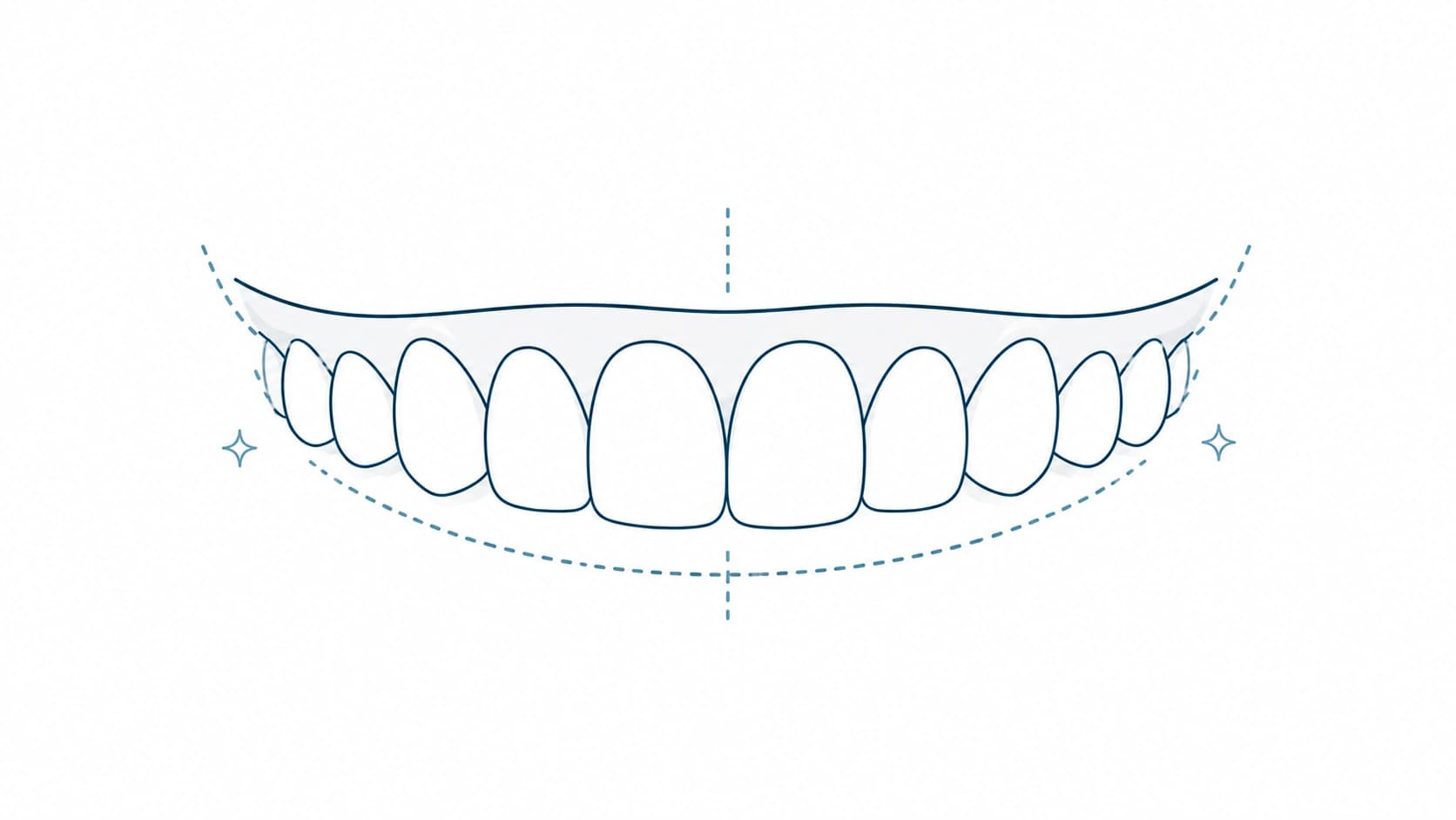 Alineación para una sonrisa más armónica