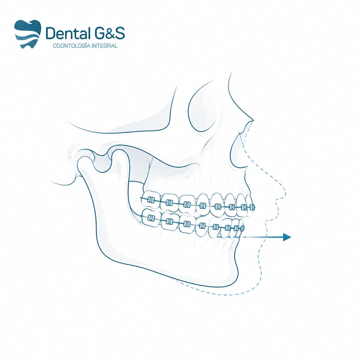 Aparato dental para tratamiento de ortodoncia y ortopedia maxilar